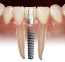 Dental Implant 1